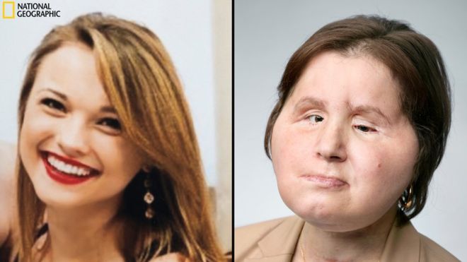 AOS 21 ANOS Americana é a mais jovem a fazer transplante de rosto