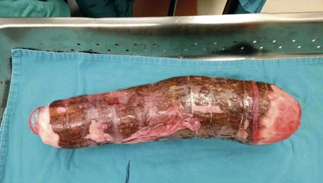 Médicos retiram mandioca de 45 cm de homem